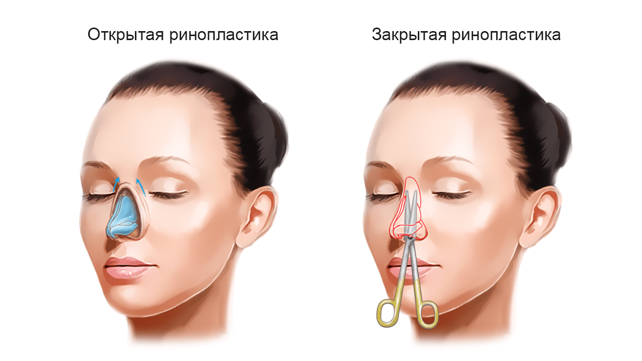 Какие операции делают на носу. Открытая и закрытая ринопластика. Ринопластика носа. Закрытая пластика носа. Закрытая ринопластика носа.