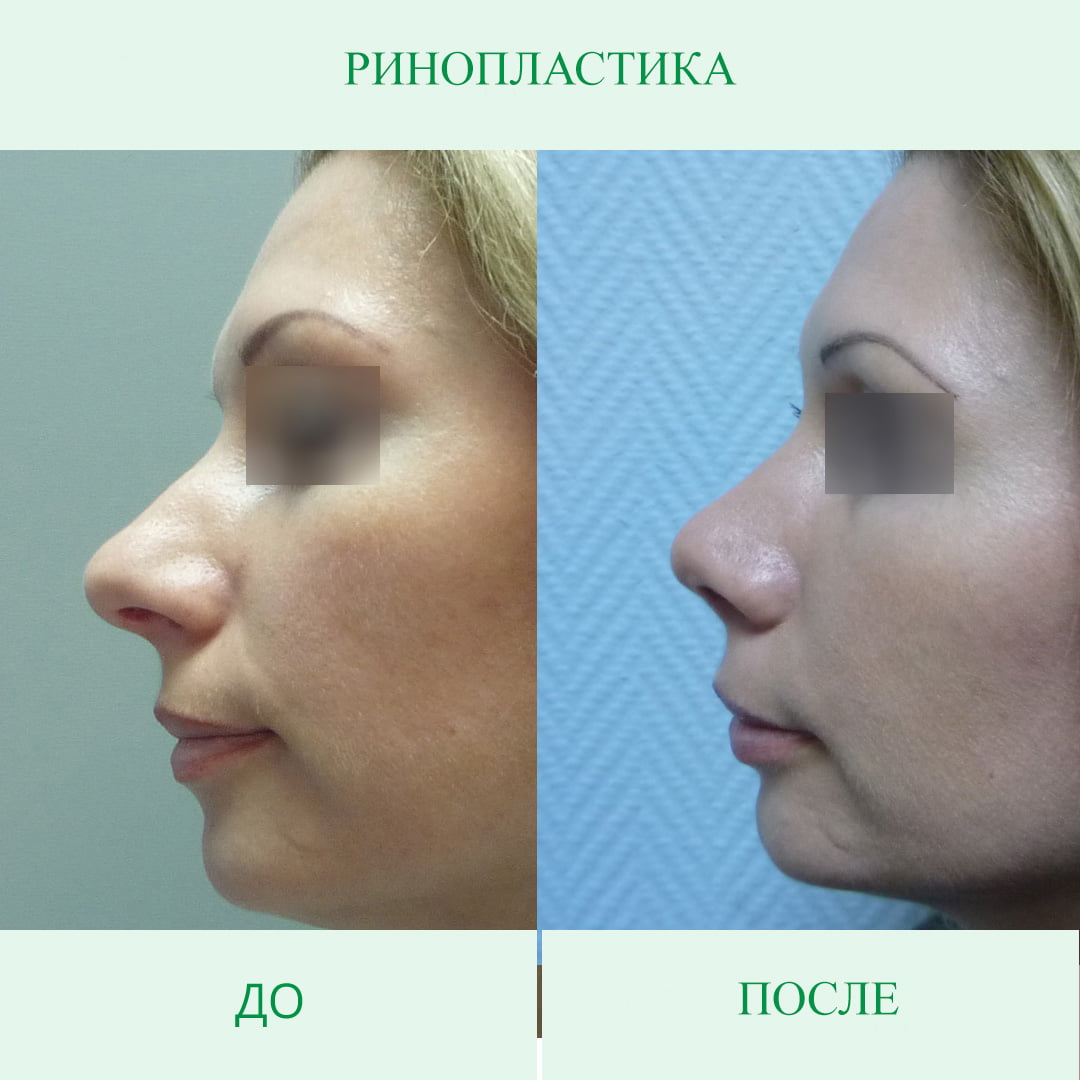 Нос после операции отзывы. Пластика носа. Ринопластика носа. Ринопластика до и после.